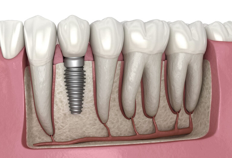 Top Reasons To Consider Dental Implants As Part Of Your Family’s Oral Care Dental Implants