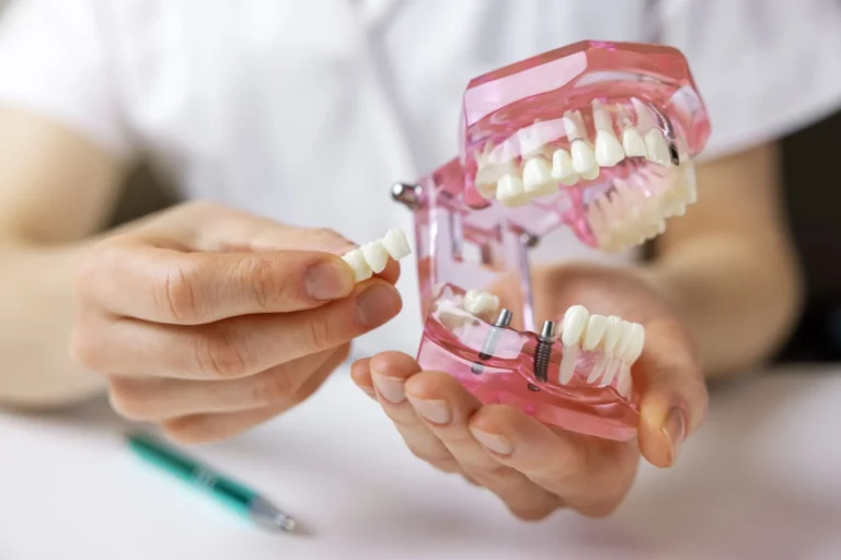 6 Essential Aftercare Tips Following Porcelain Veneer Placement Porcelain Veneer Placement